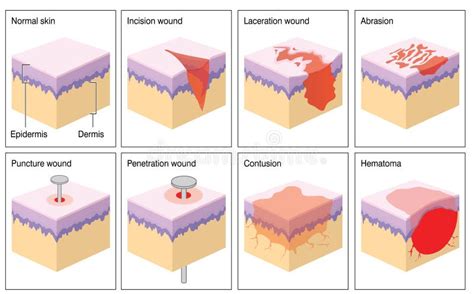 Deciphering Varied Types of Dermal Injuries within Subconscious Realm