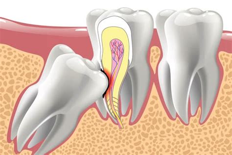 Decoding Dreams: Unveiling the Secrets Hidden within your Wisdom Teeth