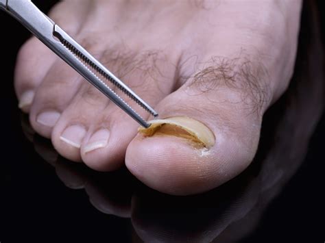 Decoding and Analyzing Your Dream of a Decayed Toenail