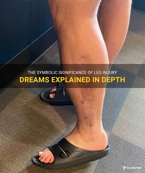 Decoding and Examining Symbolic Significance of Leg Injuries in Dreams