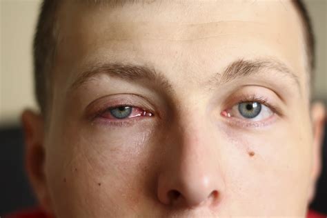 Decoding the Enigma of Swollen Left Eye: Potential Factors and Remedies