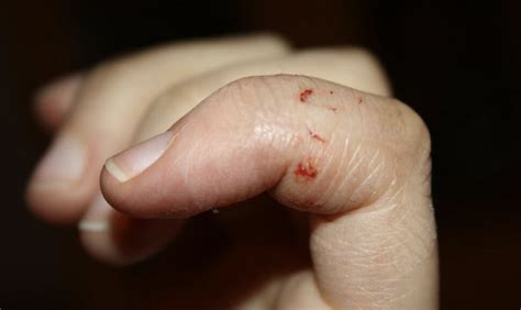 Decoding the Meaning of a Rat Bite on the Finger