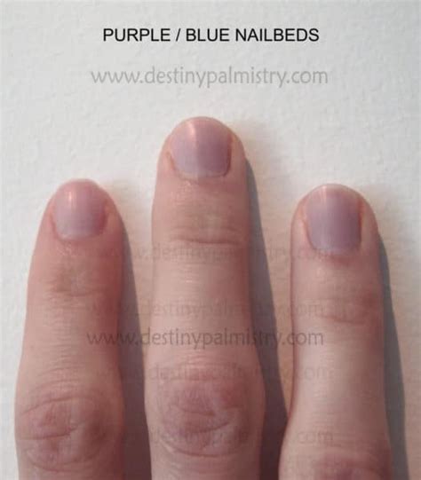 Decoding the Significance: The Link between Health Conditions and Enigmatic Violet Nails