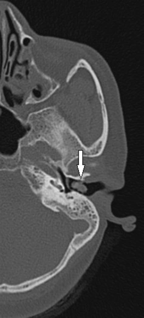 Decoding the Significance: Wax Emergence from the Auditory Canal