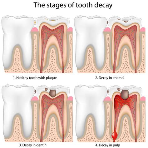 Decoding the Significance of Damaged Dental Areas: Discerning the Veiled Significations