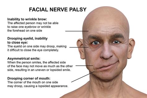 Decoding the Symbolic Significance of Facial Paralysis