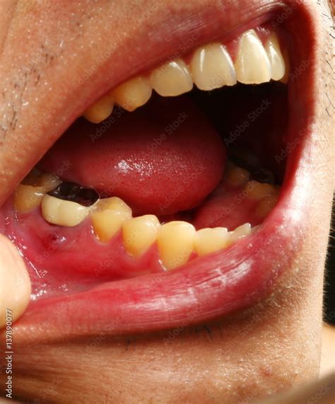 Decoding the Symbolic Significance of Painful Mouth Sores in Dreamscapes