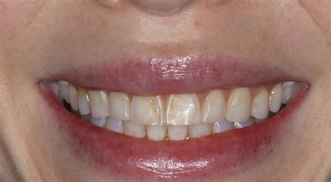 Dental Care Habits for Prevention and Reversal of Teeth Discoloration