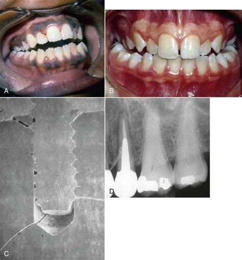 Dental Health Issues as a Contributing Factor to Tooth Fractures in Dreams