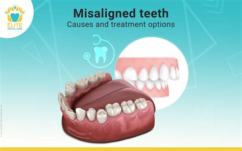 Dental Health and Misaligned Teeth