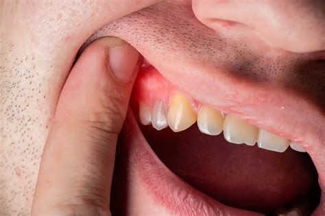 Dental Infections: A Possible Culprit for Swollen Teeth