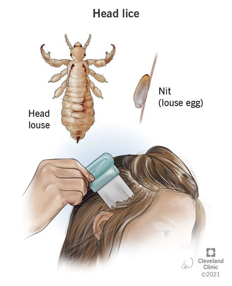 Detecting a Head Lice Infestation: Signs to Look Out For