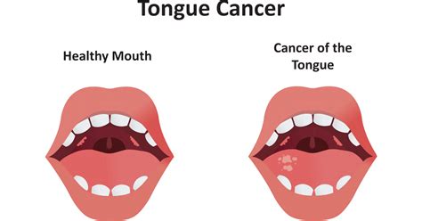 Detecting and Preventing Tongue Cancer: Key Facts to Know