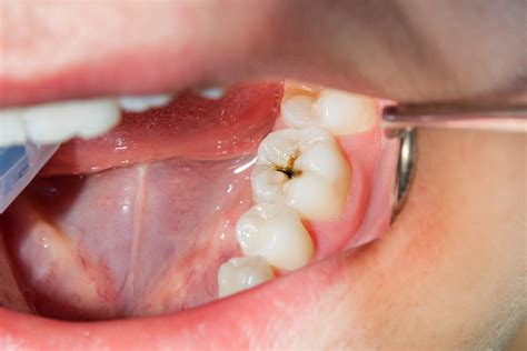 Detecting the Underlying Causes of Gum Decay