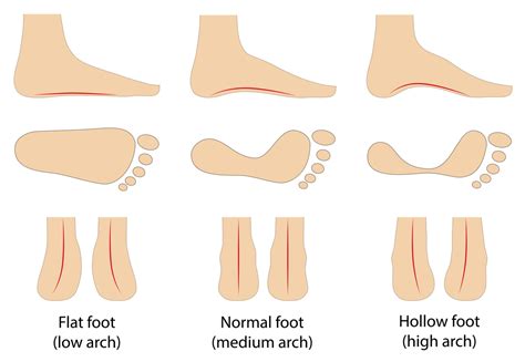 Determine Your Foot Type and Find the Ideal Sandal for Your Arch