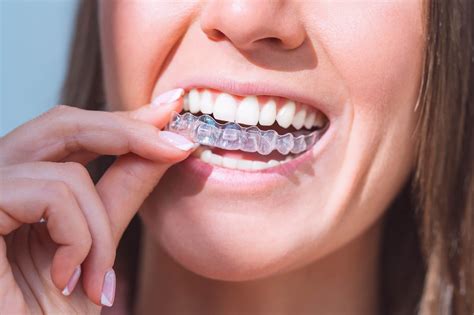 Discovering the Benefits of Invisalign Treatment