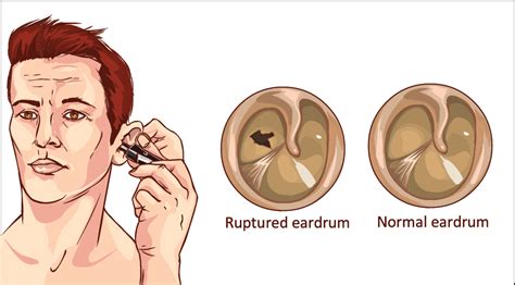 Discovering the Profound Significance Behind a Ruptured Auditory Organ in Reveries