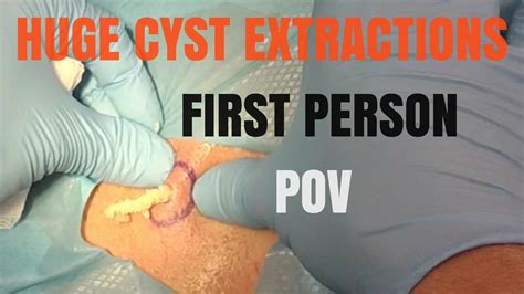 Diving into the Intriguing Realm of Cyst Extraction Videos