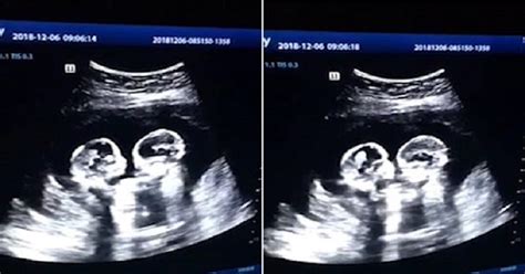 Double Trouble or Double Joy? Decoding Twin Ultrasound Images