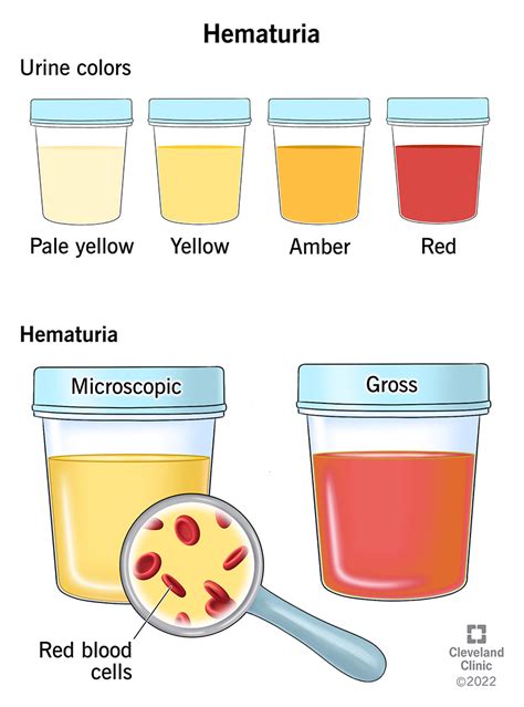 Dream Explored: Presence of Hematuria - Valuable Insights