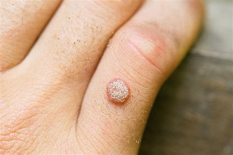 Dream of Having a Wart: What Does it Mean?