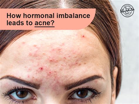 Dreaming of Pimples: A Sign of Hormonal Imbalance?