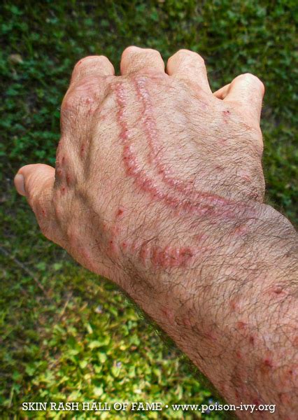 Dreaming of Poison Ivy Rash: An Unusual Symbol