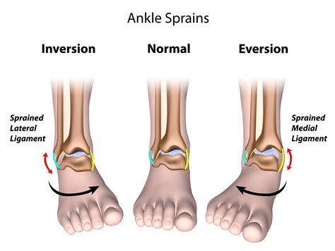 Dreaming of a Sprained Ankle: Analysis and Symbolism