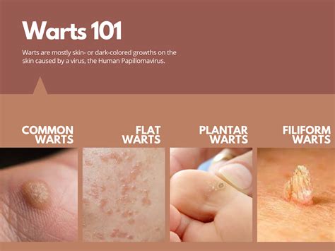 Dreams of Warts: Could They Indicate Potential Health Concerns?