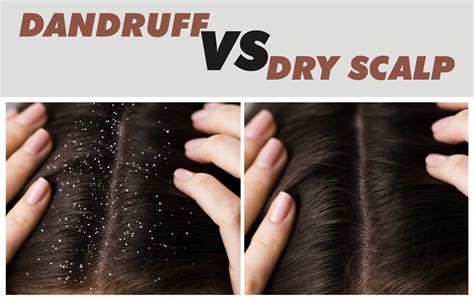 Dry scalp or dandruff: Know the difference