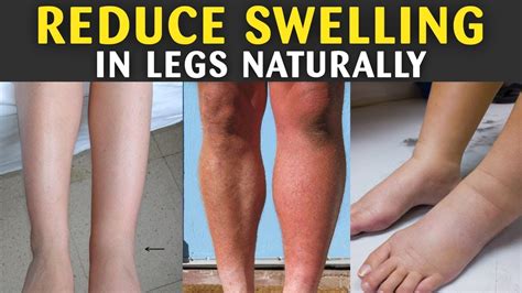 Effective Approaches to Alleviate Leg Swelling