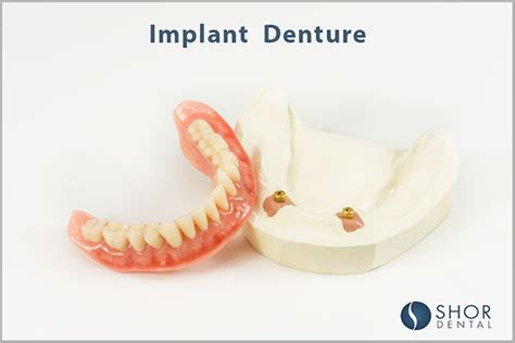 Effective Approaches to Preventing or Addressing Denture Instability