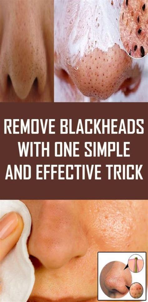 Effective and Safe Techniques for Treating Blackheads