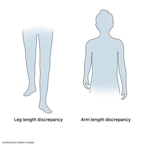 Effects of Asymmetrical Leg Length on the Body