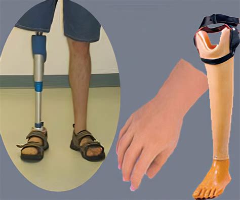 Empowering Independence: The Psychological Impact of Artificial Limbs