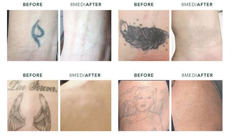 Essential Steps for Proper Care Following Tattoo Removal