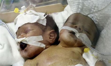 Ethical Considerations and Societal Response to Unusual Cases of Conjoined Twins