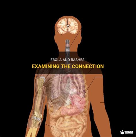 Examining Physical Health Connections in Rash Sensations Explored during Dreams