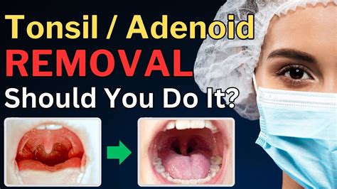 Exploring Alternative Approaches to Removing Tonsils: Worthwhile Considerations?