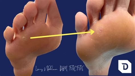 Exploring New Approaches to Conquer Resistant Plantar Warts