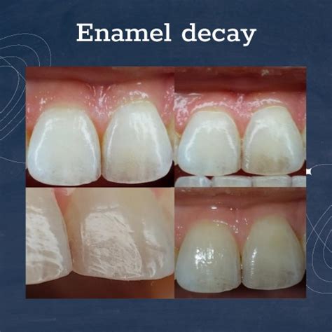 Exploring Potential Causes of Dreams with Damaged Enamel