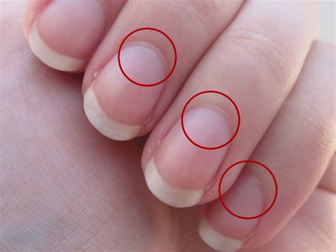 Exploring Potential Strategies to Address the Anxiety Surrounding the Loss of Thumb Nails