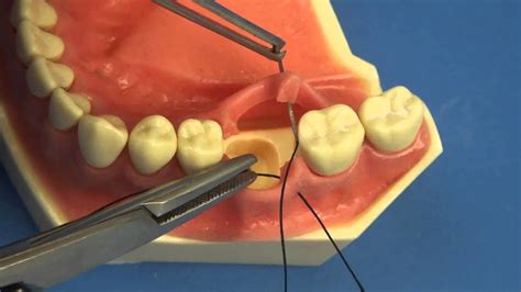 Exploring Potential Triggers for Dreams Involving Sutures in the Oral Cavity