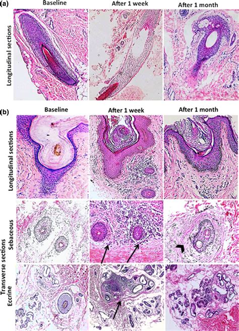 Exploring Strategies for Examining and Pondering Dreams Involving Axillary Follicles