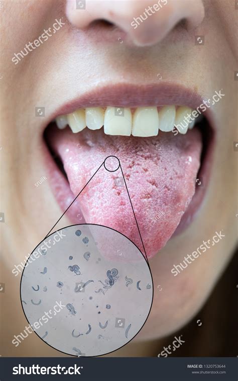 Exploring Tongue Infection: Essential Information