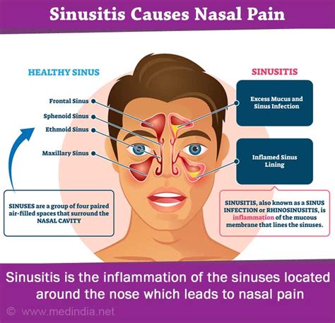 Exploring Typical Triggers of Nasal Discomfort in Fantasies