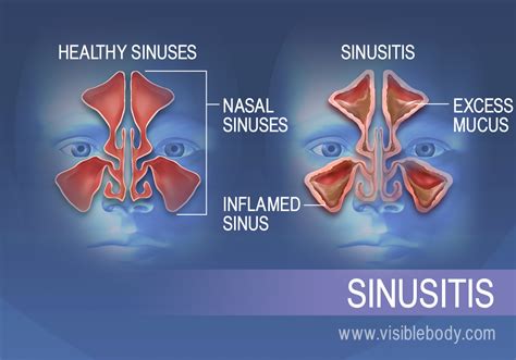 Exploring the Causes of Excessive Mucus Production in the Nasal Cavity