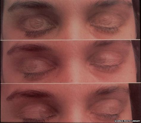 Exploring the Connection Between Fear and Dreams of Closed Eyelids