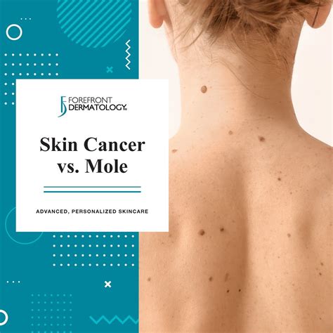 Exploring the Connection between Moles and Skin Cancer from a Medical Perspective