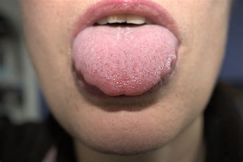 Exploring the Emotional Significance in Dreams of Enlarged Tongue